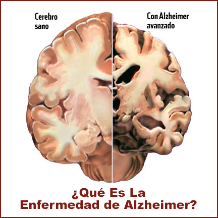 psicologiasdobrasil.com.br - Entenda mais sobre as três fases da doença de Alzheimer