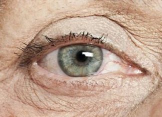 25 sintomas típicos na Doença de Alzheimer