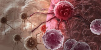 10 sintomas de câncer que a maioria das pessoas ignora