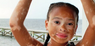 Médicos cubanos conseguem a cura para o vitiligo