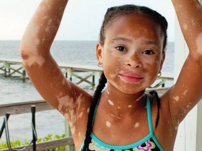 Médicos cubanos conseguem a cura para o vitiligo