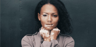 Especial Vitiligo: o que sabemos da doença e do controverso tratamento cubano até o momento.