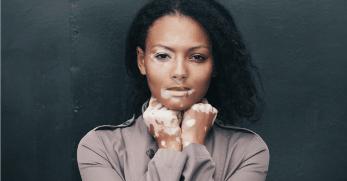 Especial Vitiligo: o que sabemos da doença e do controverso tratamento cubano até o momento.