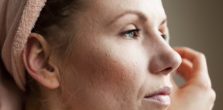 Alerta! Jovens com acne têm 63% mais chances de ficarem deprimidos