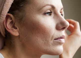 Alerta! Jovens com acne têm 63% mais chances de ficarem deprimidos