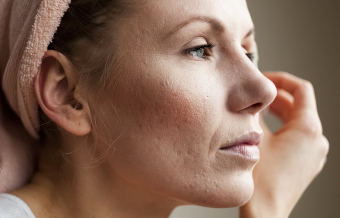 Alerta! Jovens com acne têm 63% mais chances de ficarem deprimidos