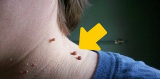 6 conselhos para eliminar naturalmente os acrocórdons