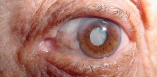 Seria o fim das cirurgias? Cientistas desenvolvem colírio que “derrete” a catarata nos olhos Seria o fim das cirurgias? Cientistas desenvolvem colírio que “derrete” a catarata nos olhos