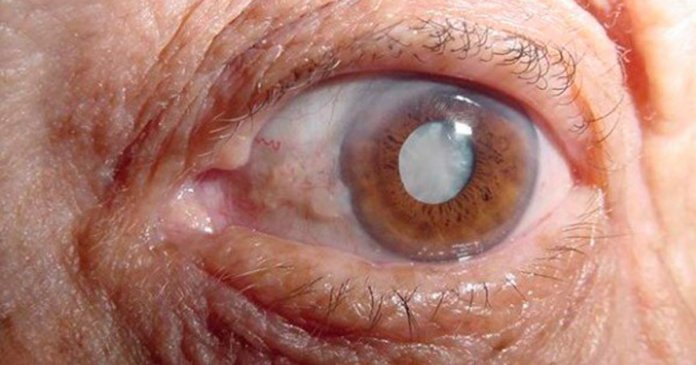 Seria o fim das cirurgias? Cientistas desenvolvem colírio que “derrete” a catarata nos olhos