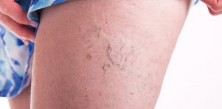 Aprenda a fazer o álcool de Alecrim e elimine a gota, varizes, dor muscular e celulite. Aprenda a fazer o álcool de Alecrim e elimine a gota, varizes, dor muscular e celulite.