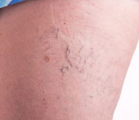 Aprenda a fazer o álcool de Alecrim e elimine a gota, varizes, dor muscular e celulite.