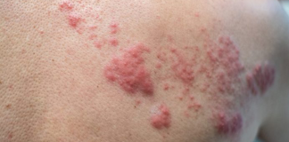 Depois dos 50, é preciso tomar a vacina contra o herpes-zóster Depois dos 50, é preciso tomar a vacina contra o herpes-zóster