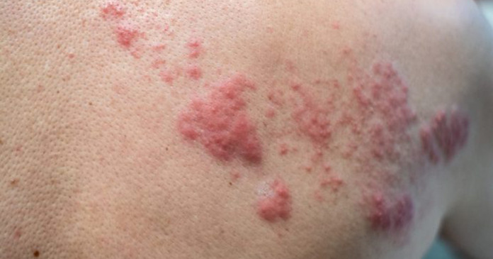 Depois dos 50, é preciso tomar a vacina contra o herpes-zóster