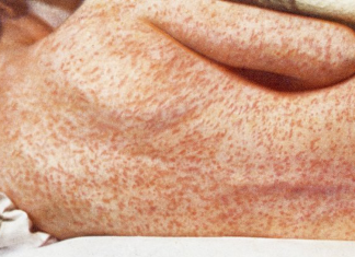 Movimento irresponsável antivacina está matando de sarampo pessoas na Europa