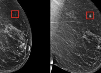 Com inteligência artificial, câncer de mama pode ser previsto cinco anos antes