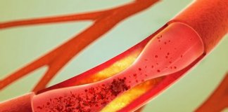 Os 12 melhores alimentos para desentupir as artérias