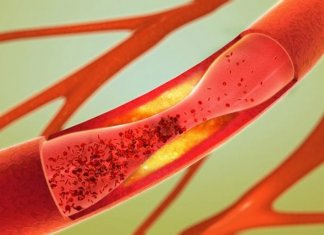 Os 12 melhores alimentos para desentupir as artérias