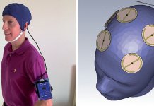 Cientistas revertem um ano de Alzheimer em dois meses através de nova invenção