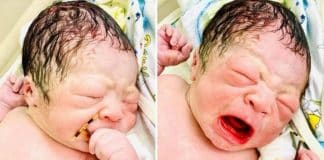 Bebê nasce segurando DIU que falhou em impedir gestação