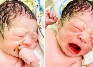 Bebê nasce segurando DIU que falhou em impedir gestação