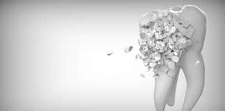 How to Fix Your Teeth After an Accident