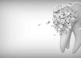 How to Fix Your Teeth After an Accident