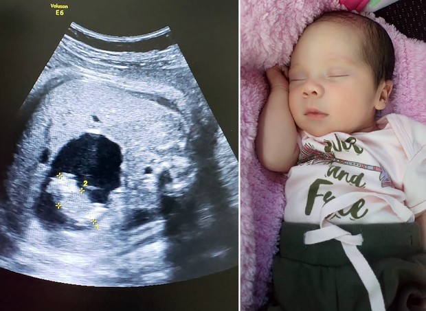 contioutra.com - Uma bebê nasceu "grávida" na Colômbia. Entenda o caso!