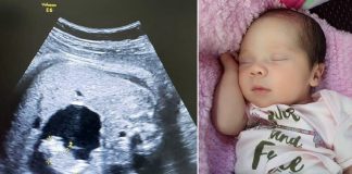 Uma bebê nasceu “grávida” na Colômbia. Entenda o caso!