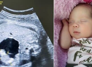 Uma bebê nasceu “grávida” na Colômbia. Entenda o caso!