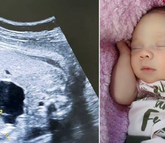 Uma bebê nasceu “grávida” na Colômbia. Entenda o caso!