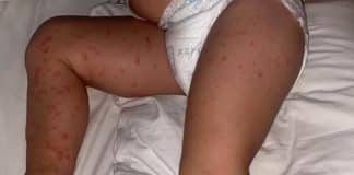 Covid deixa corpo de criança de 3 anos coberto de manchas