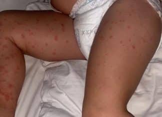 Covid deixa corpo de criança de 3 anos coberto de manchas
