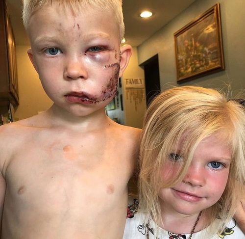 contioutra.com - A incrível recuperação do menino de 6 anos que salvou a irmãzinha do ataque de um cão feroz