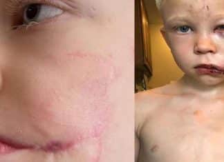A incrível recuperação do menino de 6 anos que salvou a irmãzinha do ataque de um cão feroz