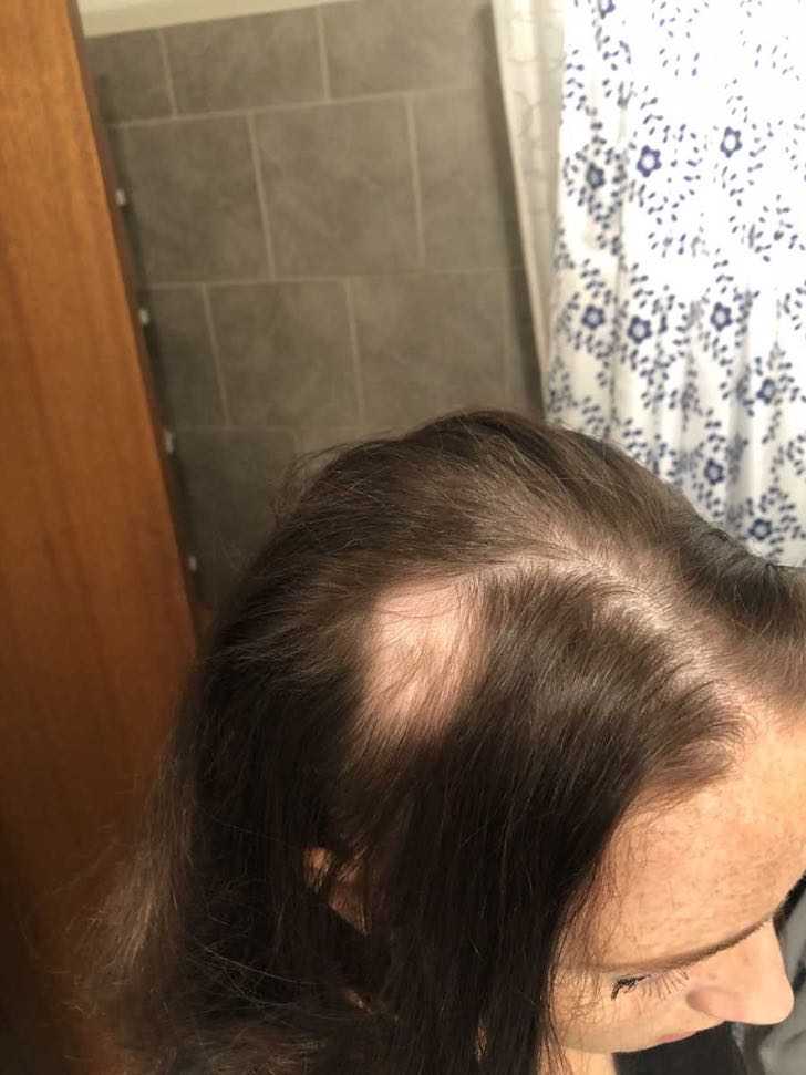 contioutra.com - "Eu me sinto bonita": jovem com alopecia deixa o medo para trás e raspa o cabelo completamente