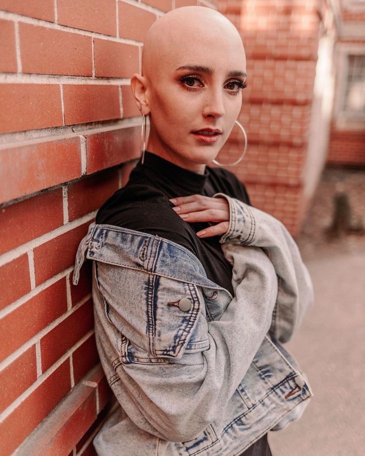 contioutra.com - "Eu me sinto bonita": jovem com alopecia deixa o medo para trás e raspa o cabelo completamente