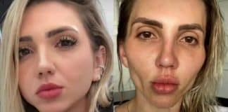 Influencer se diz arrependinda de bichectomia: ‘A minha cara caiu’