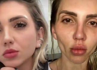 Influencer se diz arrependinda de bichectomia: ‘A minha cara caiu’