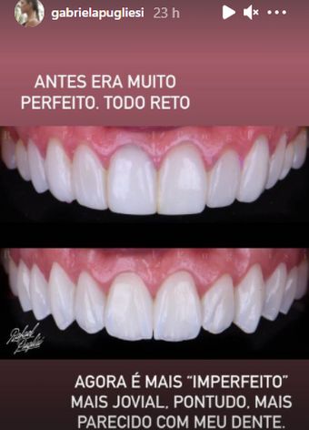 contioutra.com - Gabriela Pugliesi faz procedimento para deixar os dentes imperfeitos