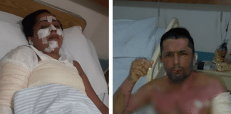 Sem gás, família se queima gravemente ao usar álcool para cozinhar e vai parar no hospital