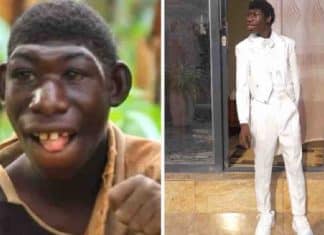 Menino com microcefalia que sofreu bullying por causa de sua aparência dá a volta por cima