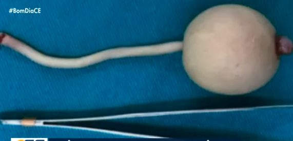 contioutra.com - Bebê prematuro nasce com cauda de 12 centímetros com uma bola na ponta e é caso raro