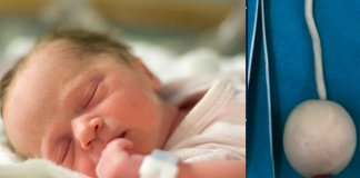 Bebê prematuro nasce com cauda de 12 centímetros com uma bola na ponta e é caso raro