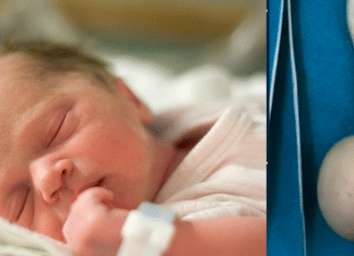 Bebê prematuro nasce com cauda de 12 centímetros com uma bola na ponta e é caso raro