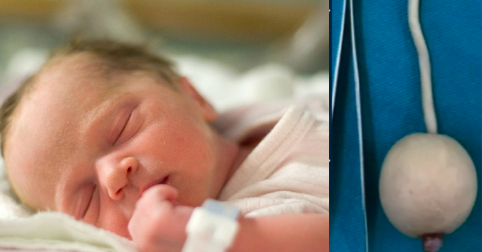 Bebê prematuro nasce com cauda de 12 centímetros com uma bola na ponta e é caso raro