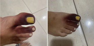 Mulher fica com dedos do pé roxos após ter piolho-de-cobra preso no sapato: “Comecei a gritar!”