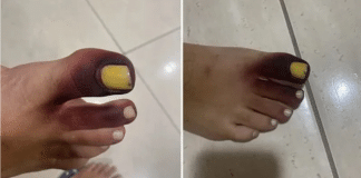 Mulher fica com dedos do pé roxos após ter piolho-de-cobra preso no sapato: “Comecei a gritar!” Mulher fica com dedos do pé roxos após ter piolho-de-cobra preso no sapato: “Comecei a gritar!”