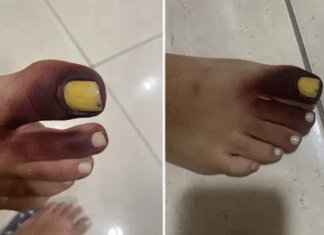 Mulher fica com dedos do pé roxos após ter piolho-de-cobra preso no sapato: “Comecei a gritar!”