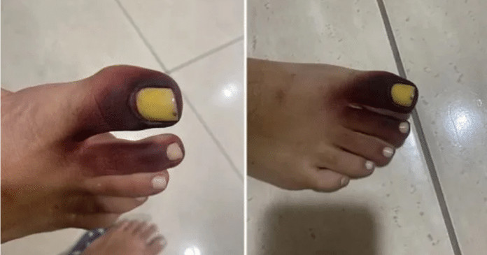 Mulher fica com dedos do pé roxos após ter piolho-de-cobra preso no sapato: “Comecei a gritar!”