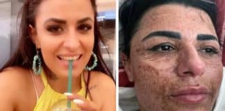 Mulher tem rosto queimado após esteticista distrair-se com celular